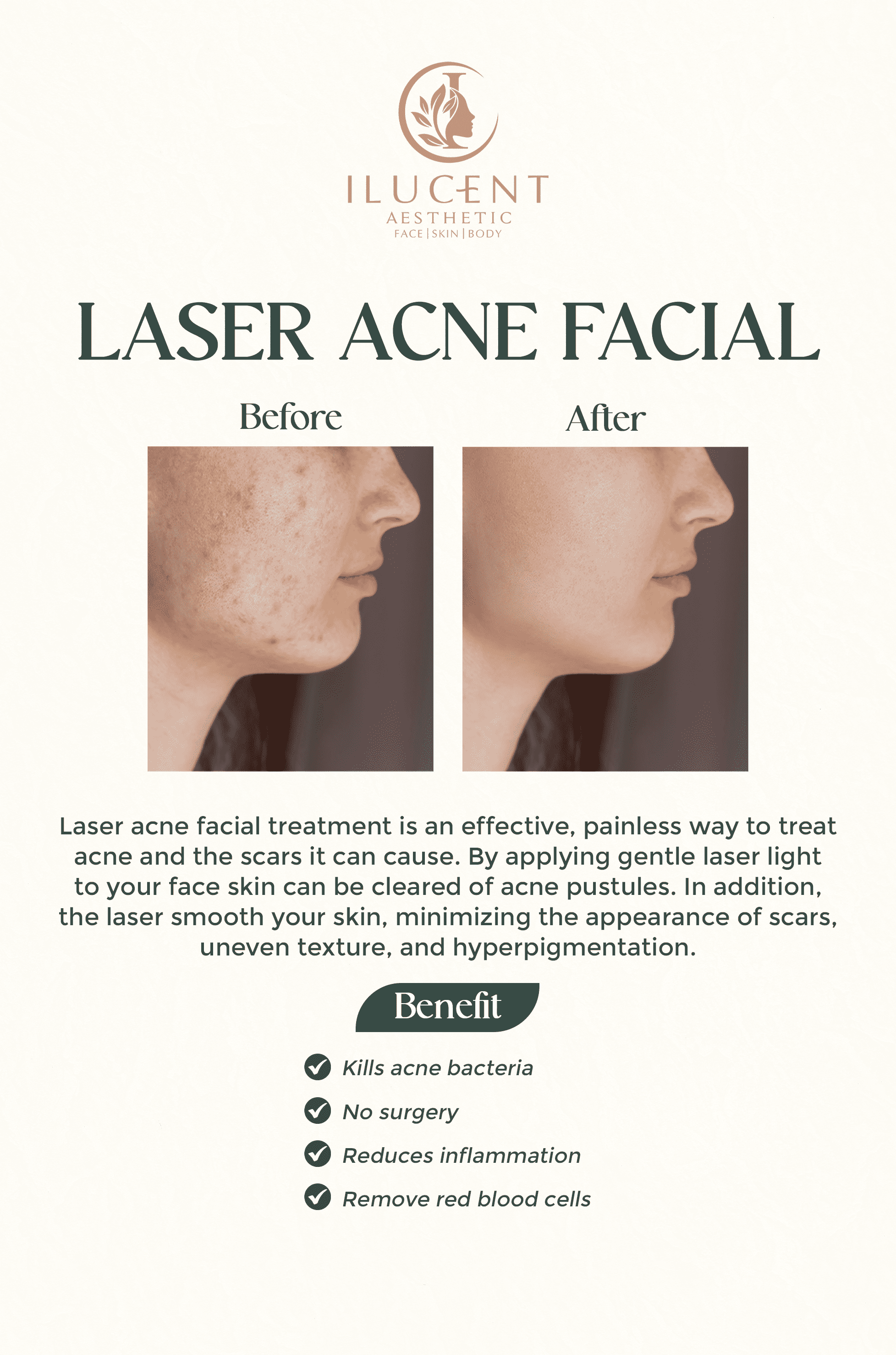 Laser Ance Facial