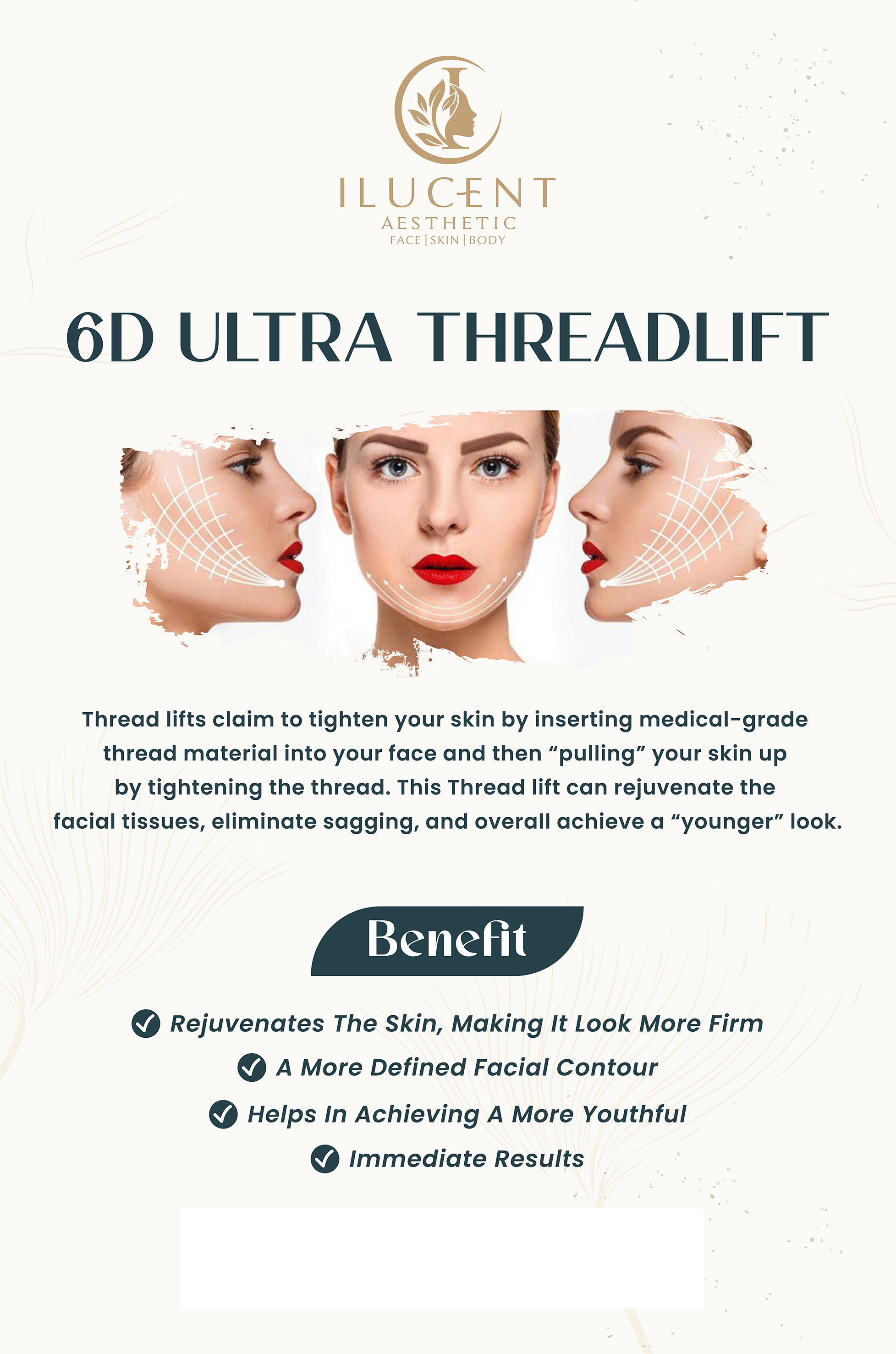 6D Ultra Threadlift