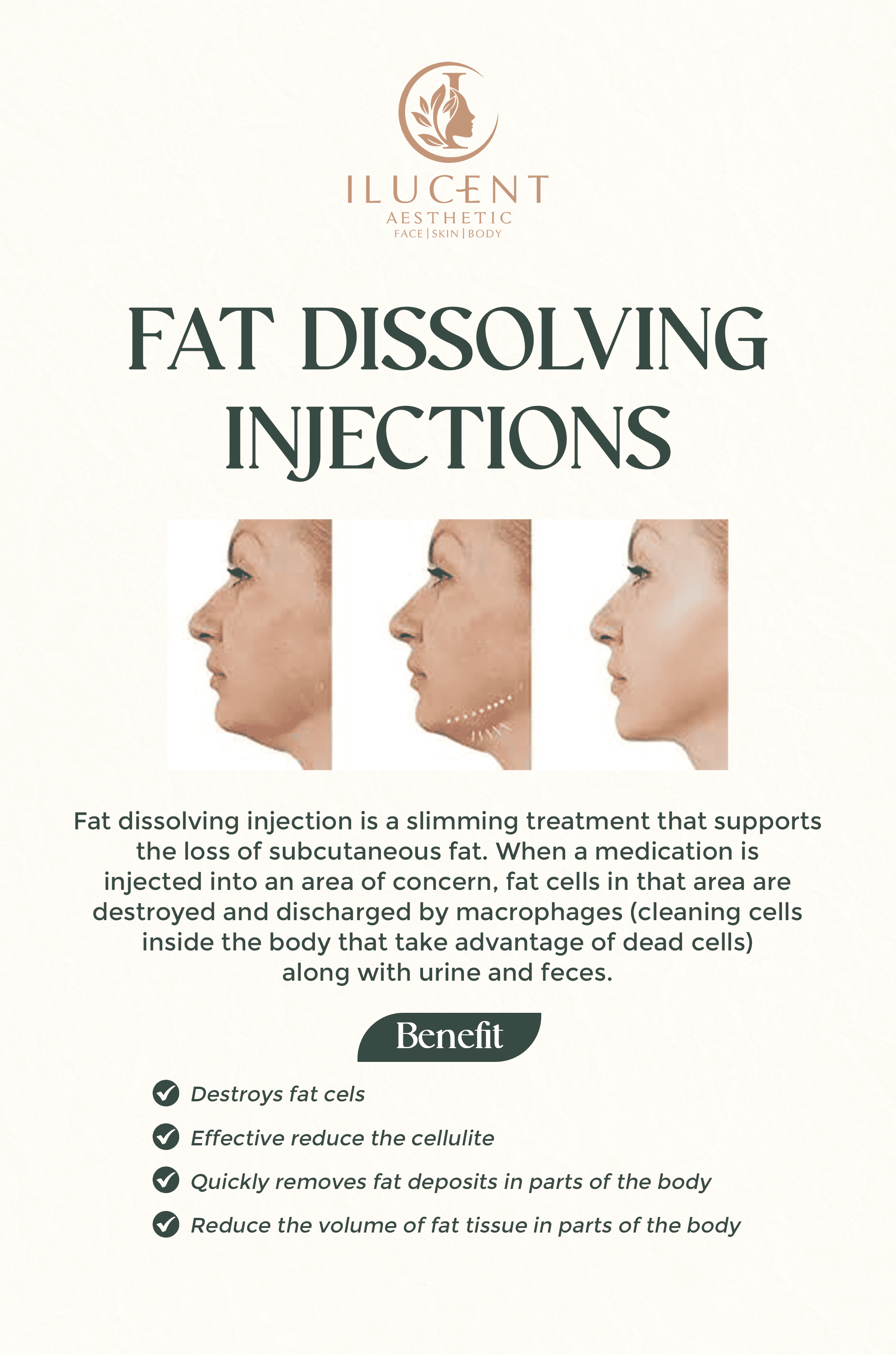 Fat Dissolving Injection