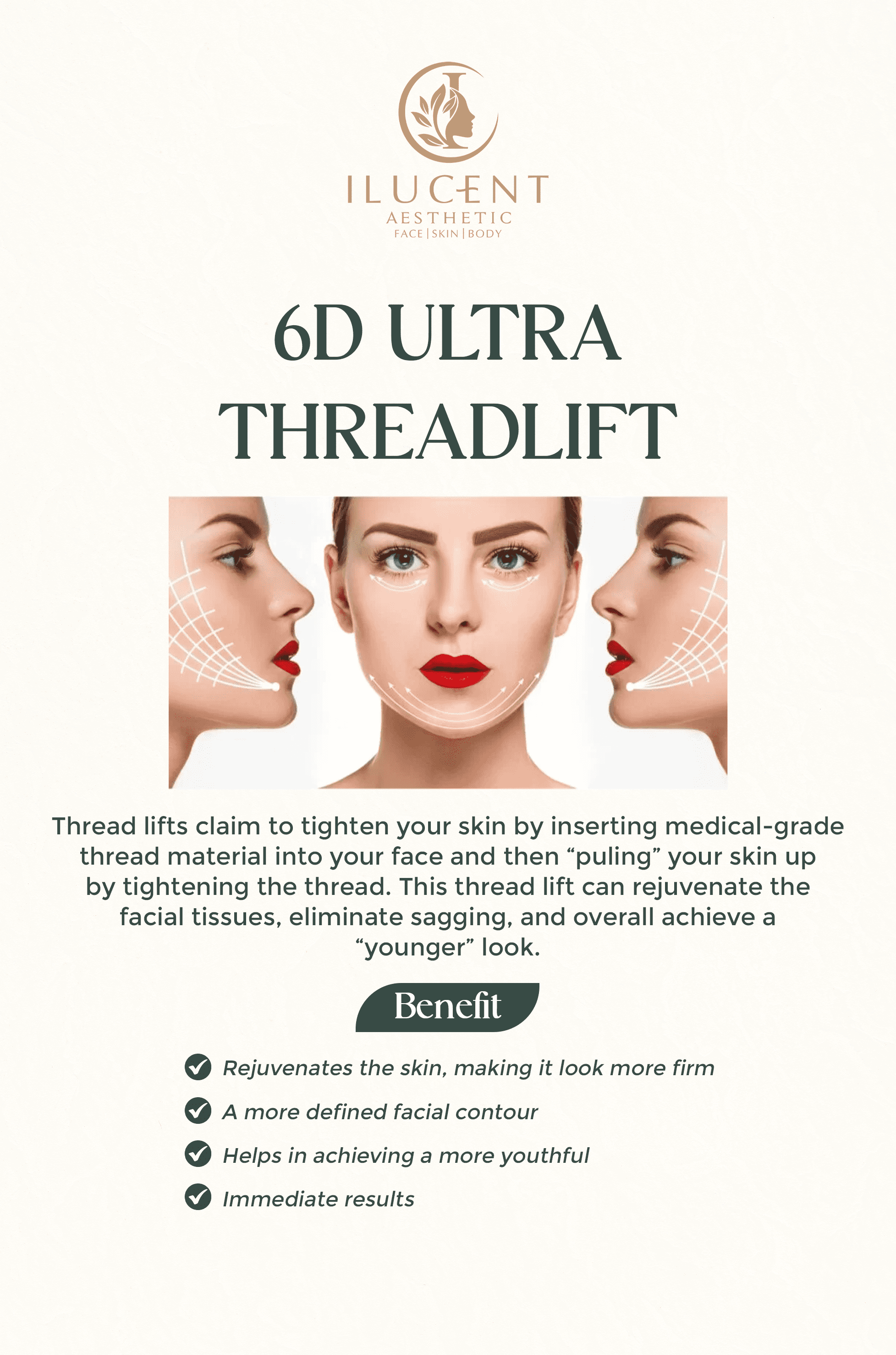 6D Ultra Threadlift